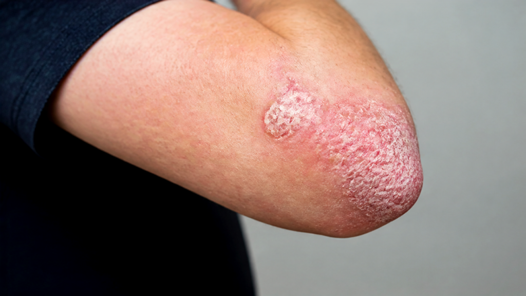 Psoriasis skin patches on elbow