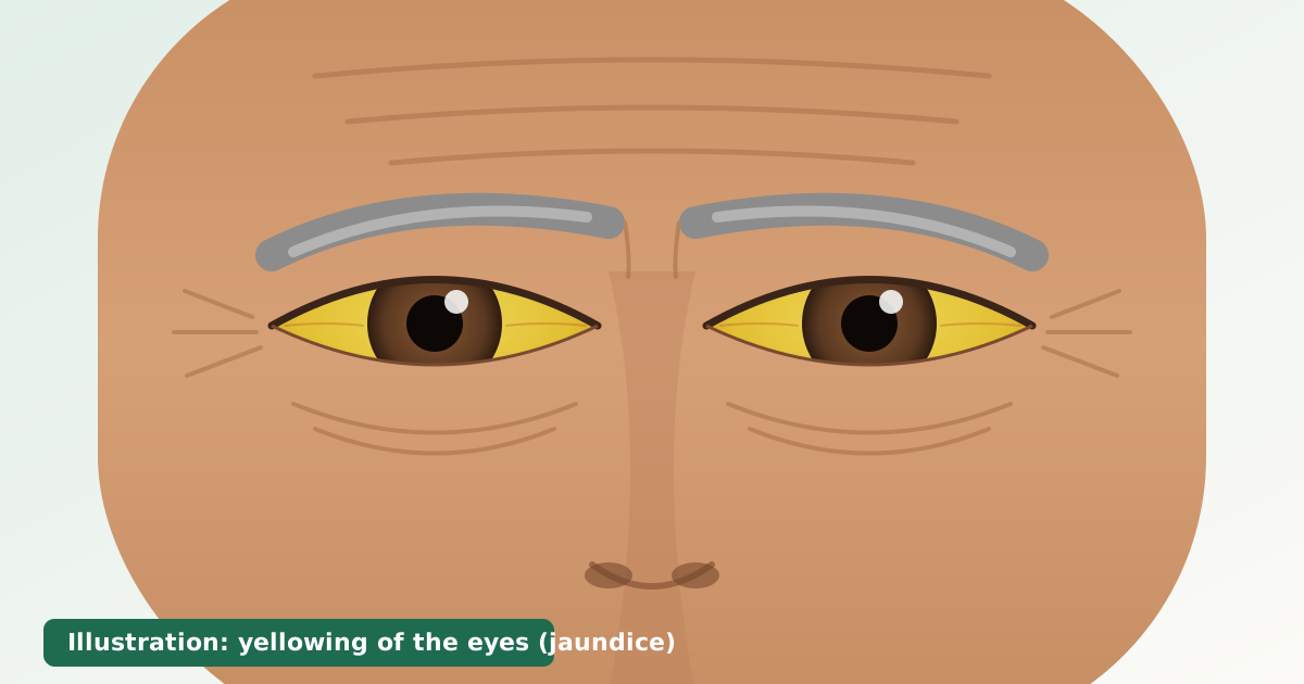 Illustration of yellowing of the eyes (jaundice) in an older man. Illustrative image only, not the patient.