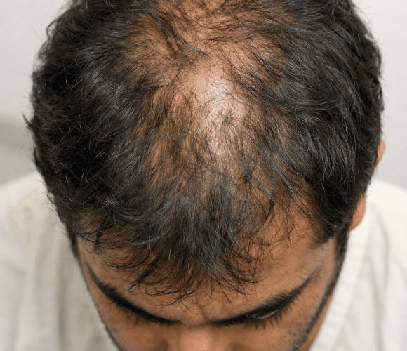 Hair Loss